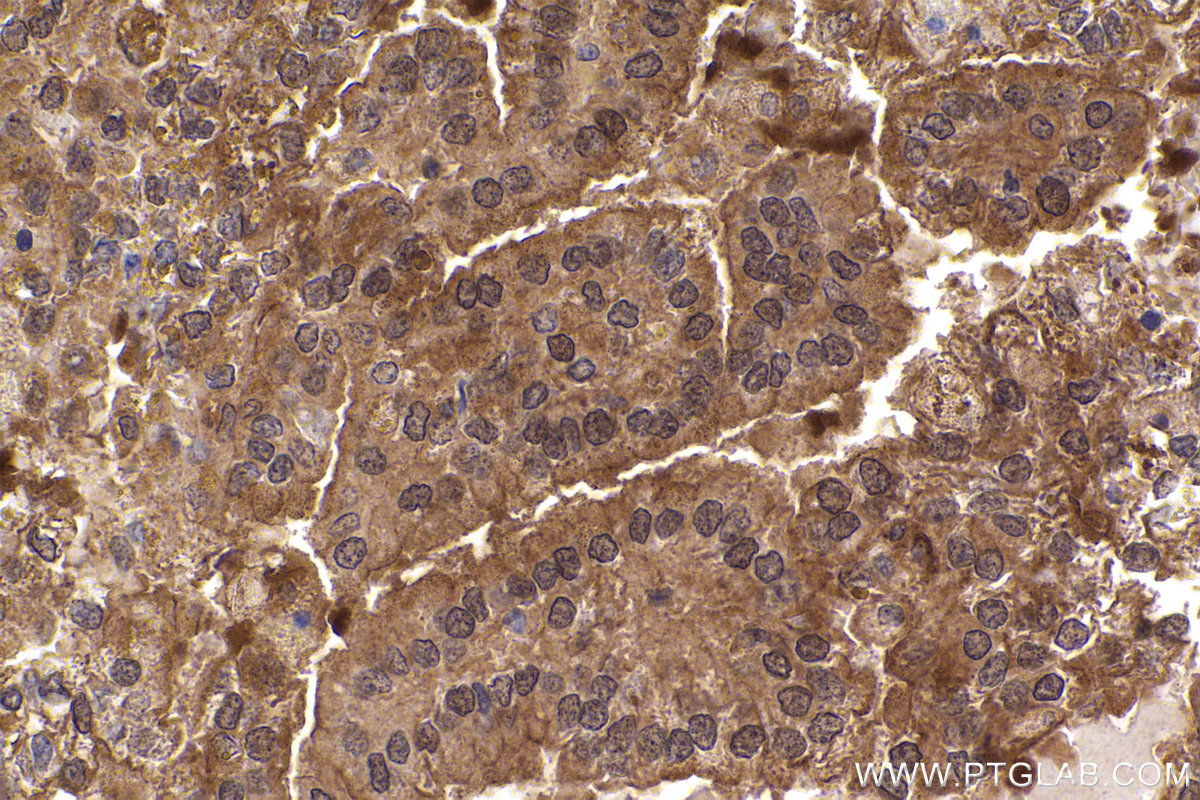Immunohistochemical analysis of paraffin-embedded human renal cell carcinoma tissue slide using KHC2377 (XIAP IHC Kit).