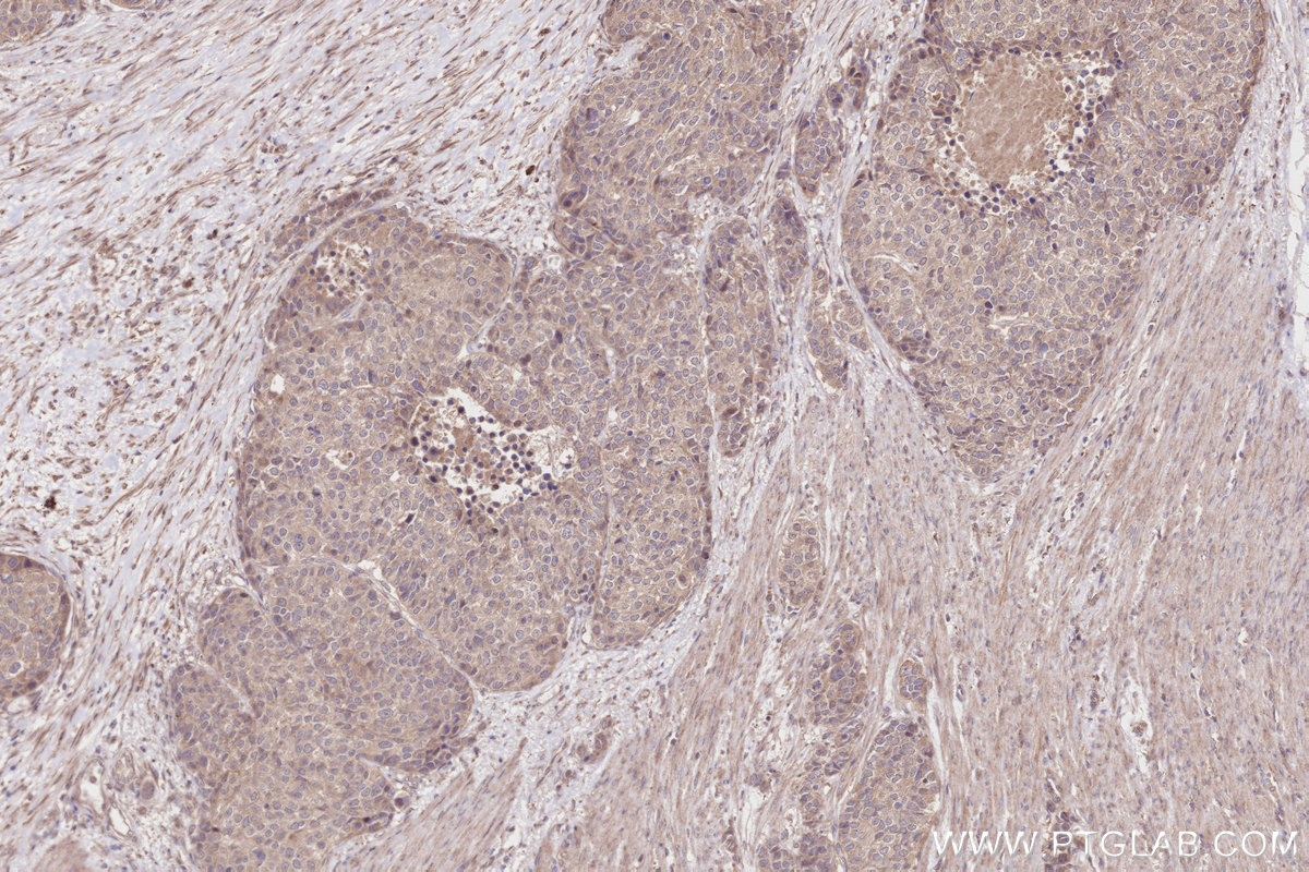 Immunohistochemical analysis of paraffin-embedded human stomach cancer tissue slide using KHC2822 (XPO6 IHC Kit).
