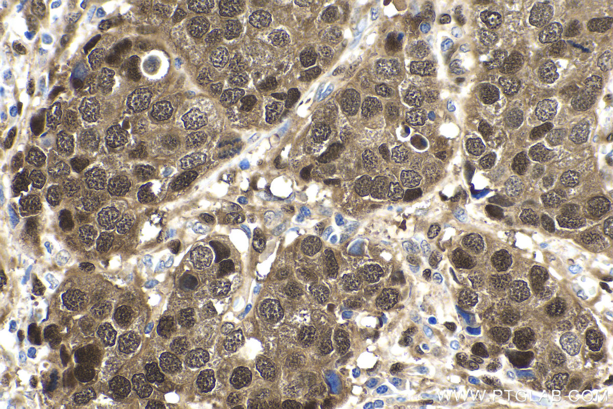 Immunohistochemical analysis of paraffin-embedded human stomach cancer tissue slide using KHC1608 (YAP1 IHC Kit).