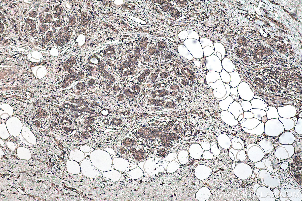 Immunohistochemical analysis of paraffin-embedded human breast cancer tissue slide using KHC0157 (YTHDF1 IHC Kit).
