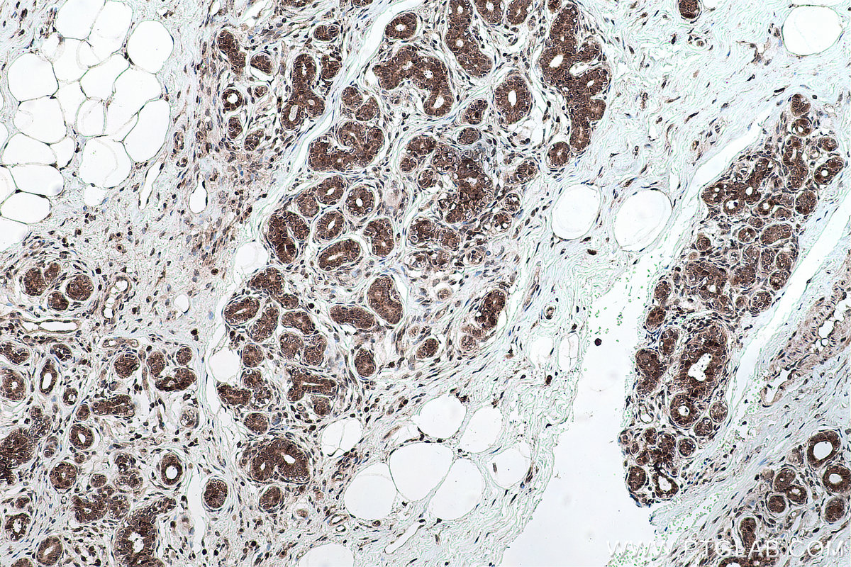 Immunohistochemical analysis of paraffin-embedded human breast cancer tissue slide using KHC0159 (YTHDF3-specific IHC Kit).