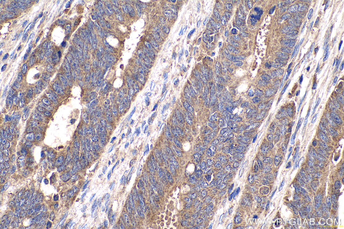 Immunohistochemical analysis of paraffin-embedded human colon cancer tissue slide using KHC0701 (YWHAB IHC Kit).