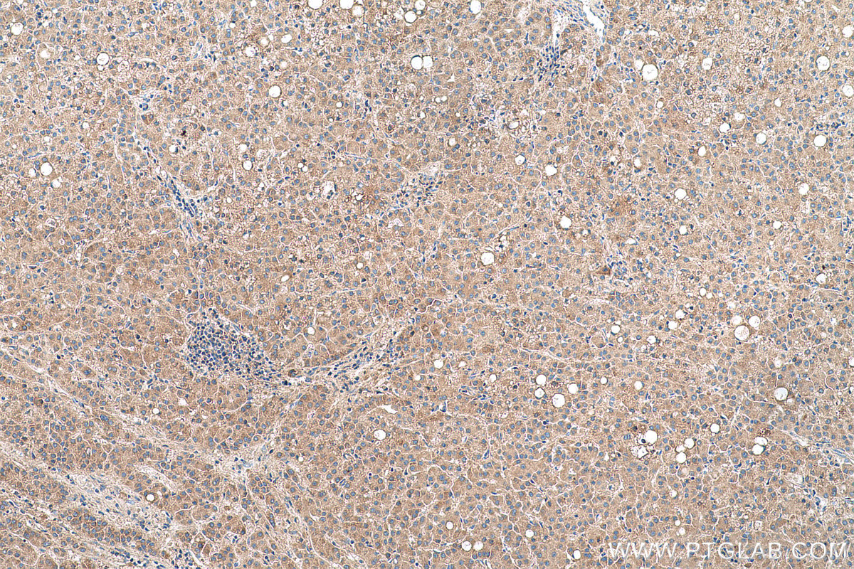 Immunohistochemical analysis of paraffin-embedded human liver cancer tissue slide using KHC0701 (YWHAB IHC Kit).