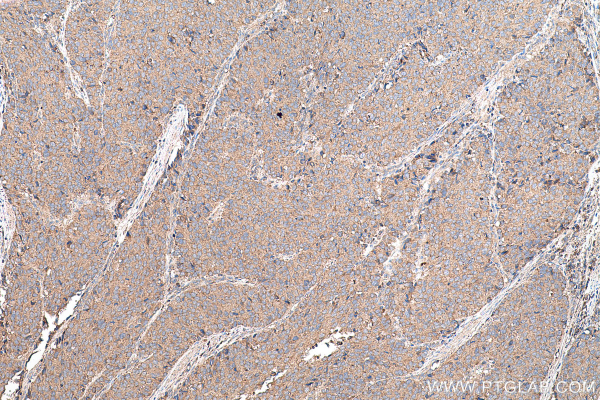 Immunohistochemical analysis of paraffin-embedded human stomach cancer tissue slide using KHC0701 (YWHAB IHC Kit).