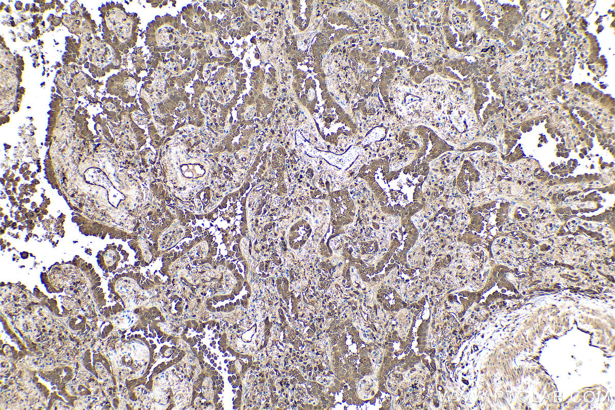 Immunohistochemical analysis of paraffin-embedded human lung cancer tissue slide using KHC0558 (YWHAE IHC Kit).