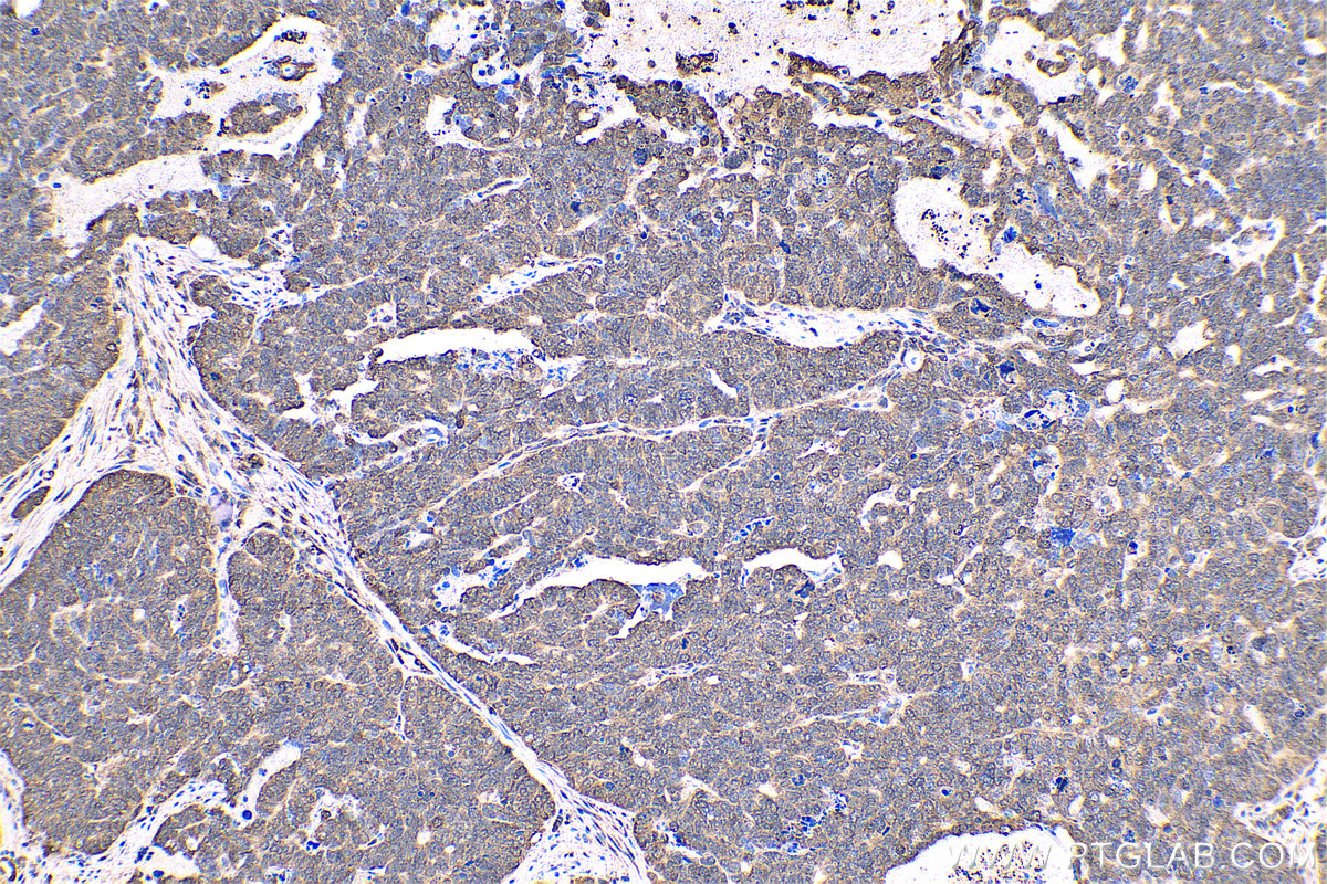 Immunohistochemical analysis of paraffin-embedded human ovary tumor tissue slide using KHC0558 (YWHAE IHC Kit).