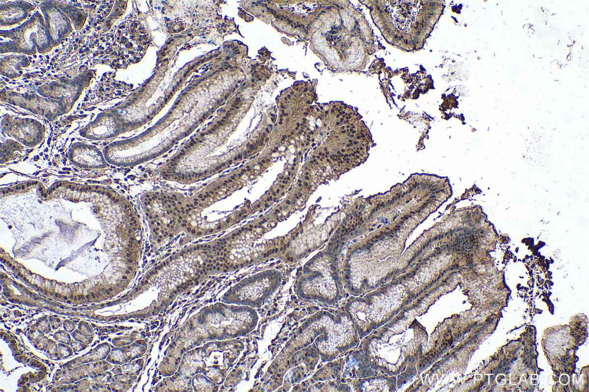 Immunohistochemical analysis of paraffin-embedded human stomach cancer tissue slide using KHC0559 (YWHAZ IHC Kit).