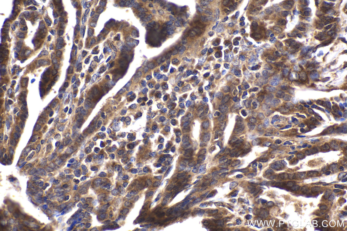 Immunohistochemical analysis of paraffin-embedded human thyroid cancer tissue slide using KHC2038 (ZC3H12D IHC Kit).