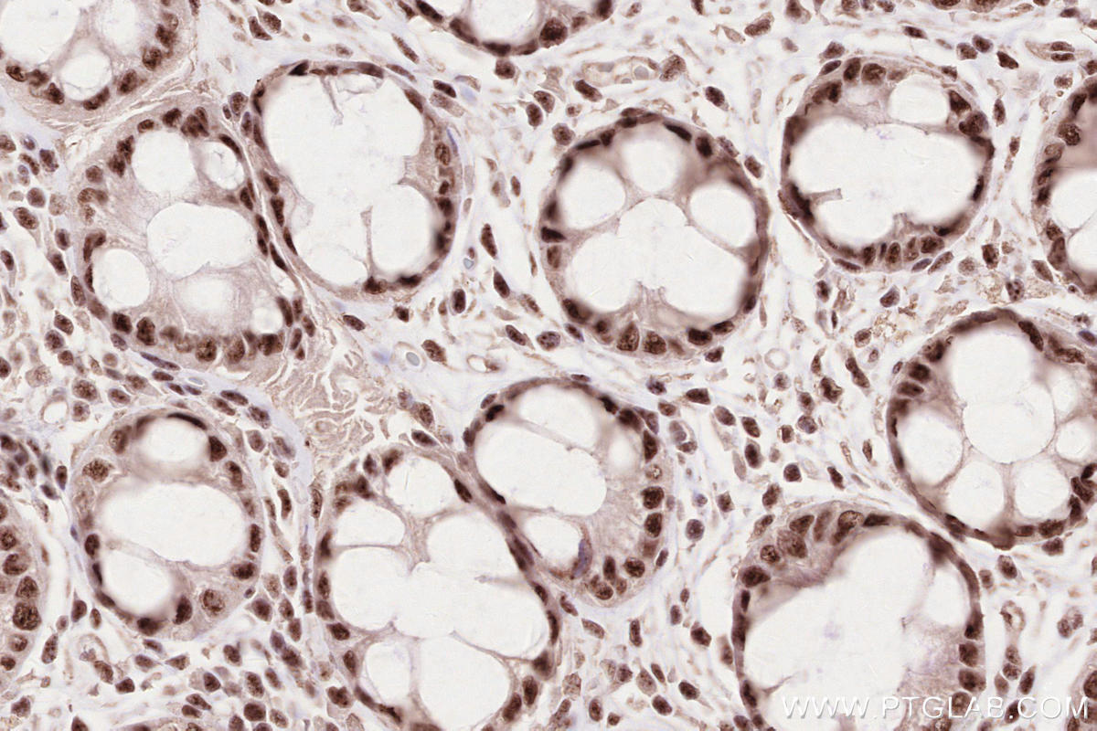 Immunohistochemical analysis of paraffin-embedded human rectal cancer tissue slide using KHC2593 (ZC3H14 IHC Kit).