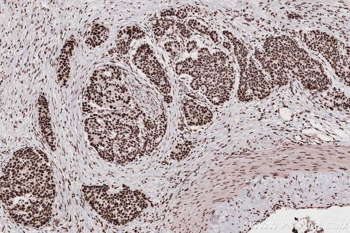 Immunohistochemical analysis of paraffin-embedded human stomach cancer tissue slide using KHC2692 (ZC3H18 IHC Kit).