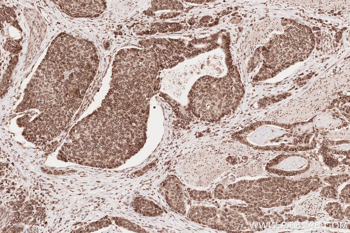 Immunohistochemical analysis of paraffin-embedded human stomach cancer tissue slide using KHC2637 (ZC3HC1 IHC Kit).