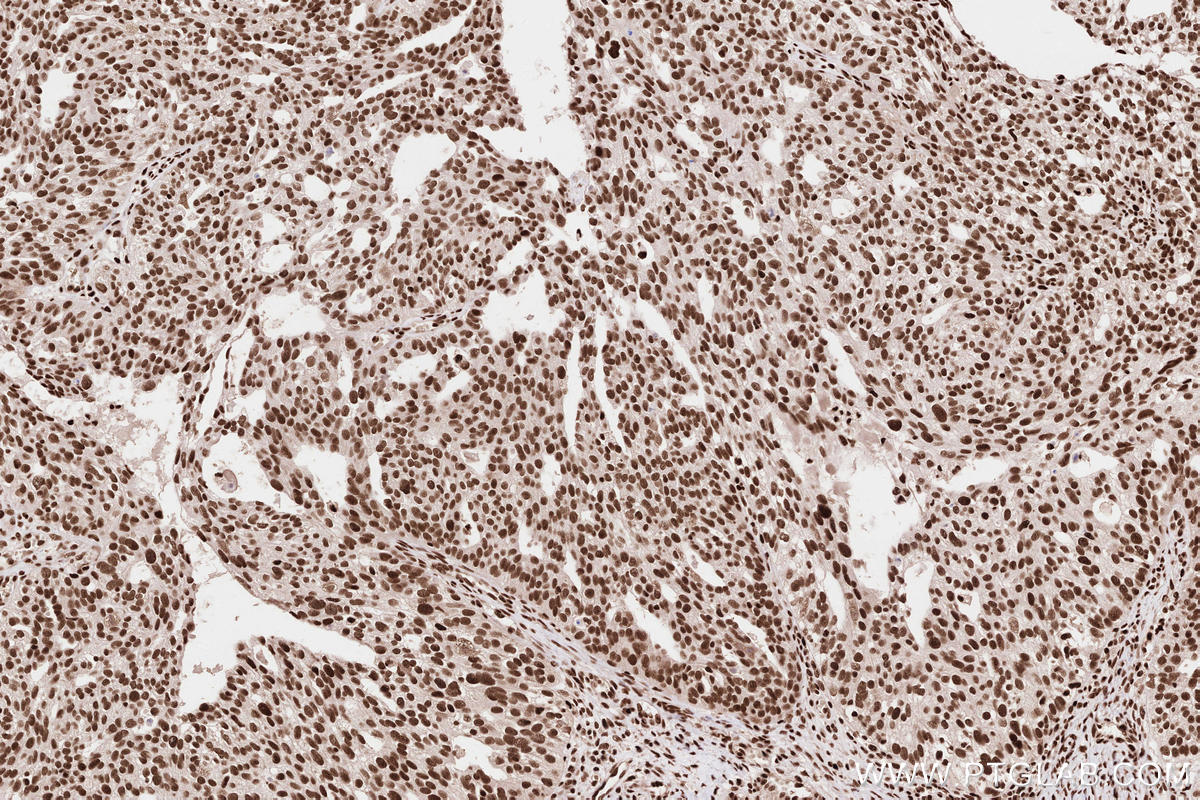 Immunohistochemical analysis of paraffin-embedded human ovary cancer tissue slide using KHC2584 (ZCCHC8 IHC Kit).