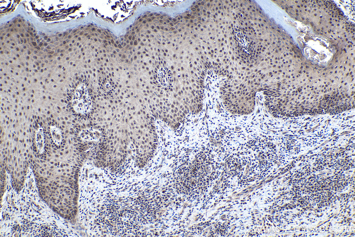 Immunohistochemical analysis of paraffin-embedded human skin cancer tissue slide using KHC1567 (ZFP36 IHC Kit).