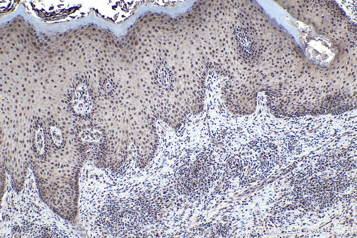 Immunohistochemical analysis of paraffin-embedded human skin cancer tissue slide using KHC1567 (ZFP36 IHC Kit).