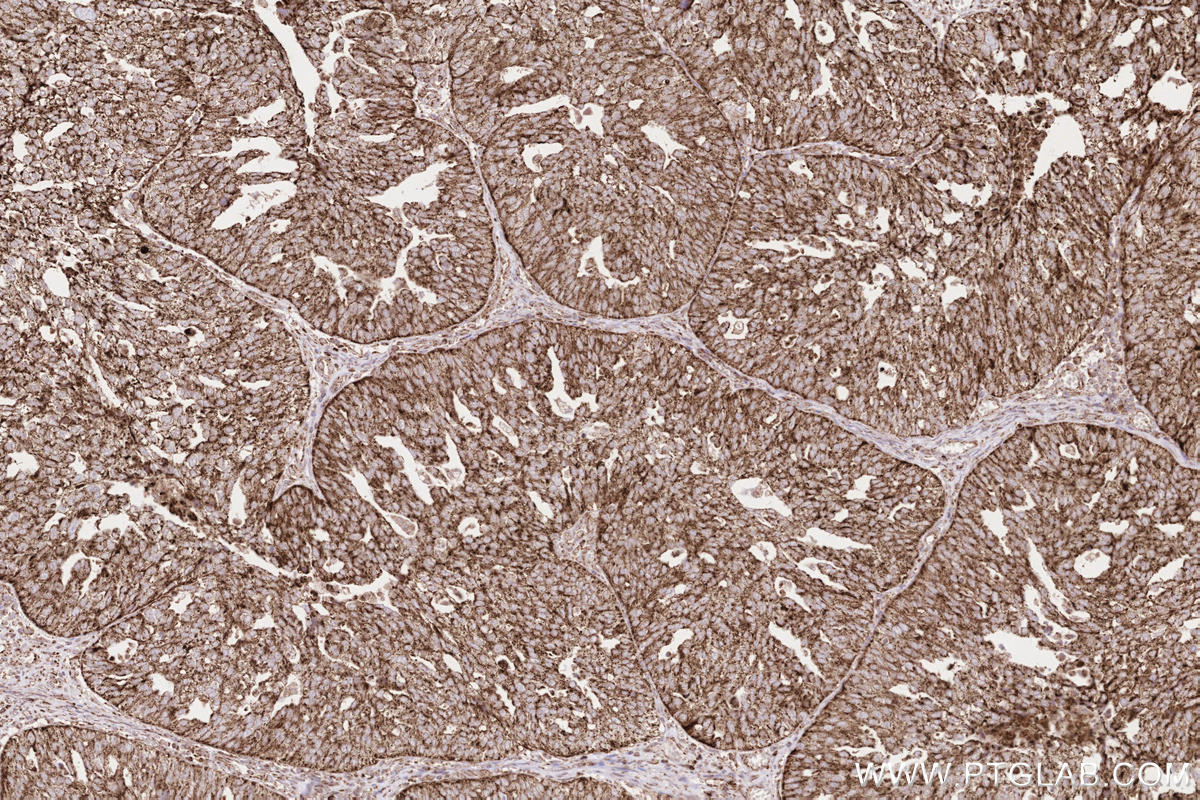 Immunohistochemical analysis of paraffin-embedded human ovary cancer tissue slide using KHC2572 (ZFYVE26 IHC Kit).