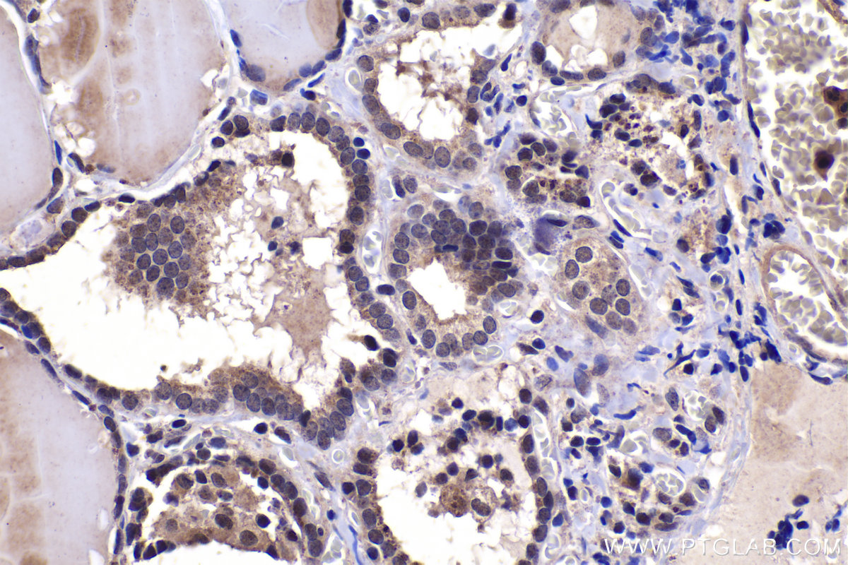 Immunohistochemical analysis of paraffin-embedded human thyroid cancer tissue slide using KHC1467 (ZIC3 IHC Kit).