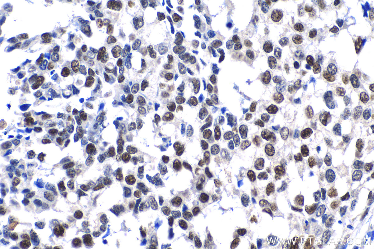 Immunohistochemical analysis of paraffin-embedded human breast cancer tissue slide using KHC1399 (ZMYM3 IHC Kit).