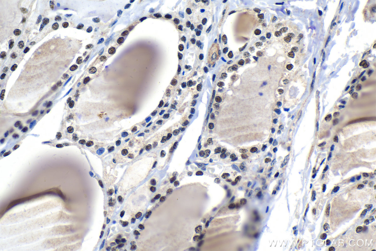 Immunohistochemical analysis of paraffin-embedded human thyroid cancer tissue slide using KHC1552 (ZNF24 IHC Kit).