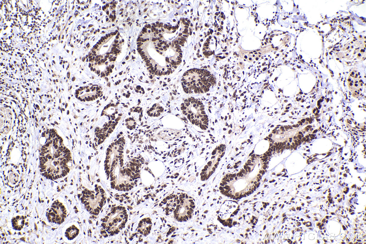 Immunohistochemical analysis of paraffin-embedded human rectal cancer tissue slide using KHC2470 (ZNF638 IHC Kit).