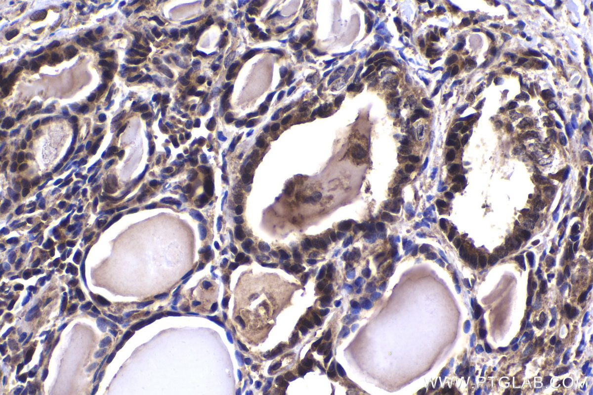 Immunohistochemical analysis of paraffin-embedded human thyroid cancer tissue slide using KHC1472 (ZPR1 IHC Kit).