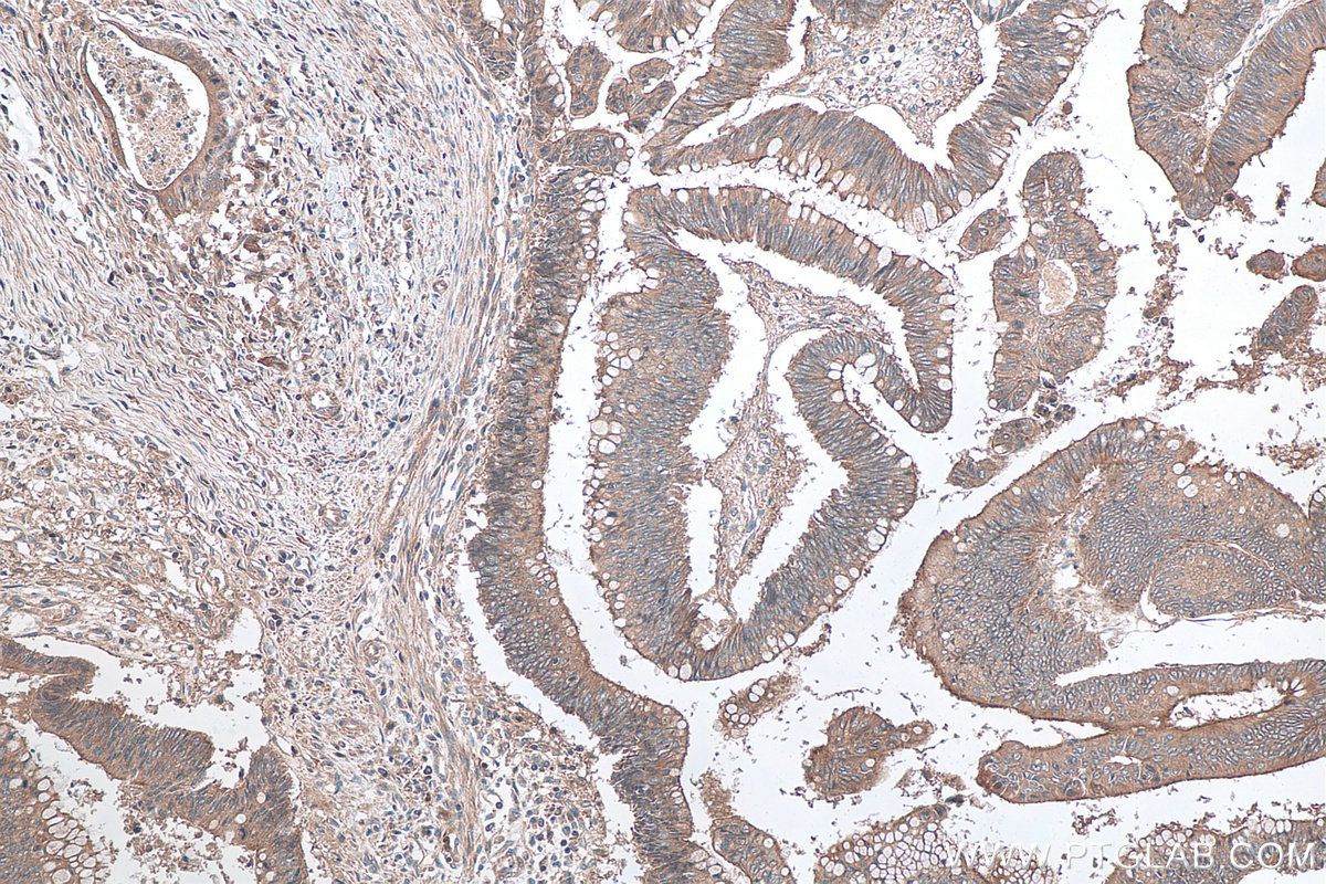 Immunohistochemical analysis of paraffin-embedded human colon cancer tissue slide using KHC0117 (c-SRC IHC Kit).