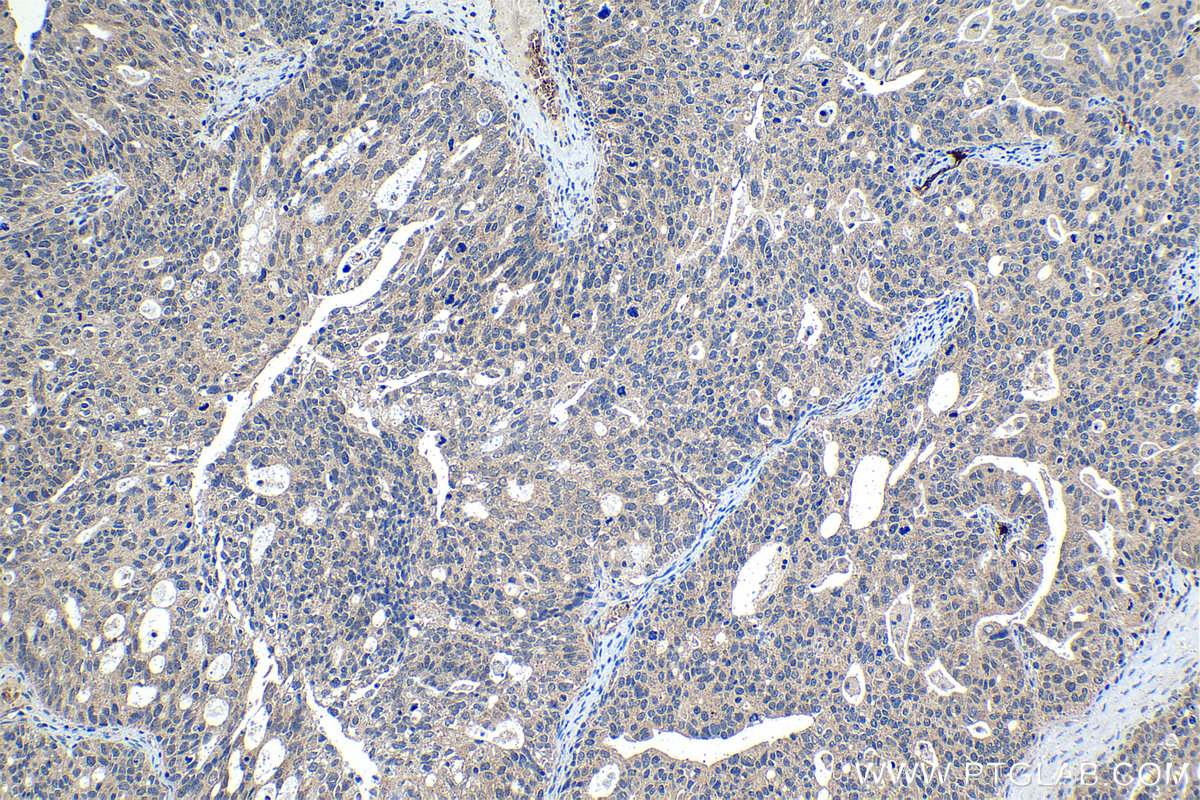 Immunohistochemical analysis of paraffin-embedded human ovary tumor tissue slide using KHC1118 (cIAP2/BIRC3 IHC Kit).