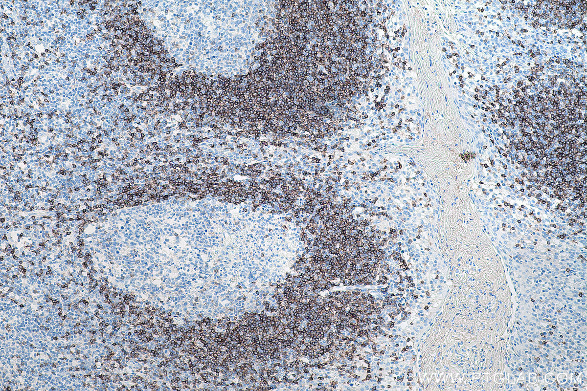 Immunohistochemical analysis of paraffin-embedded human tonsillitis tissue slide using KHC0071 (human IgD IHC Kit).