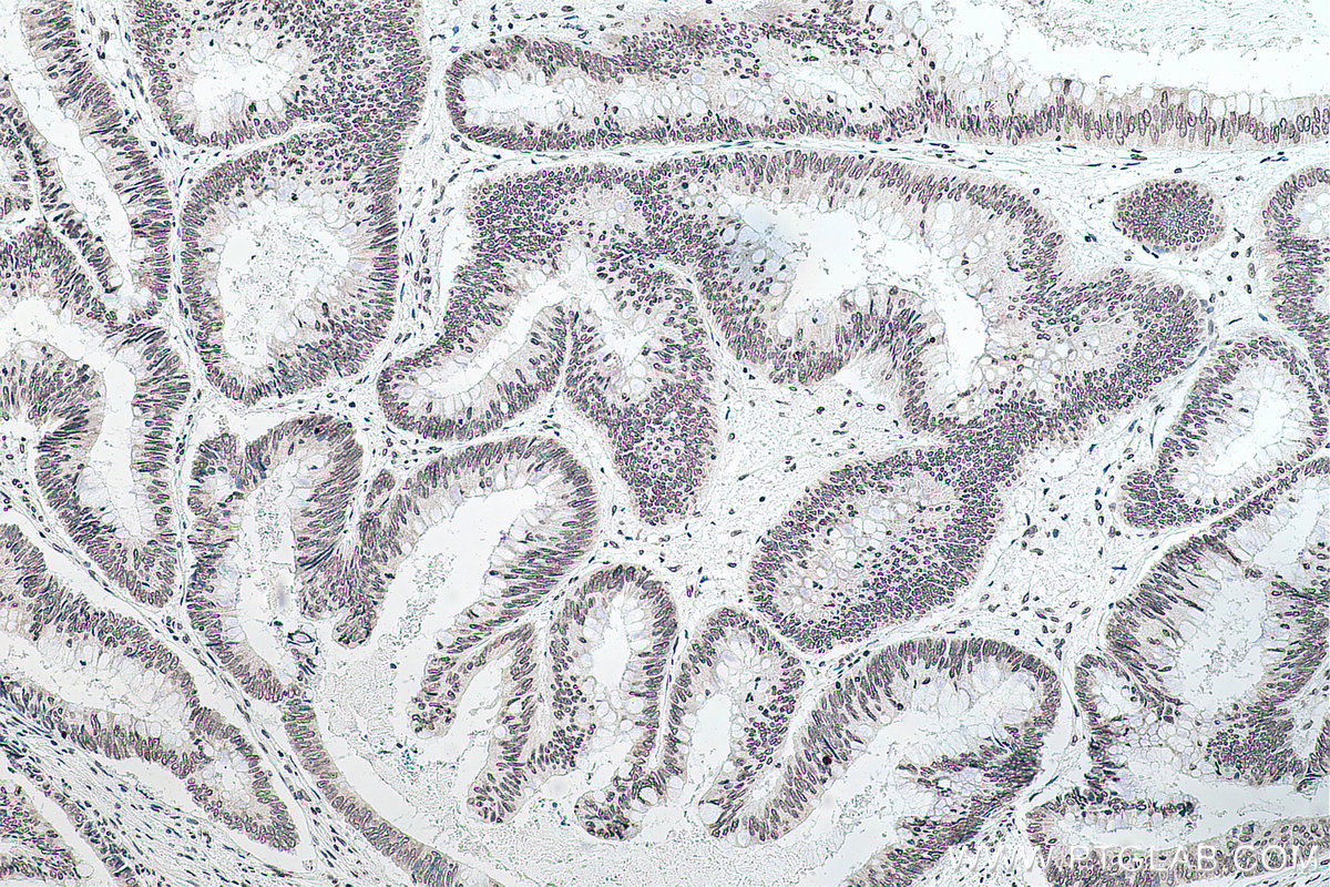 Immunohistochemical analysis of paraffin-embedded human colon cancer tissue slide using KHC0143 (m6A IHC Kit).