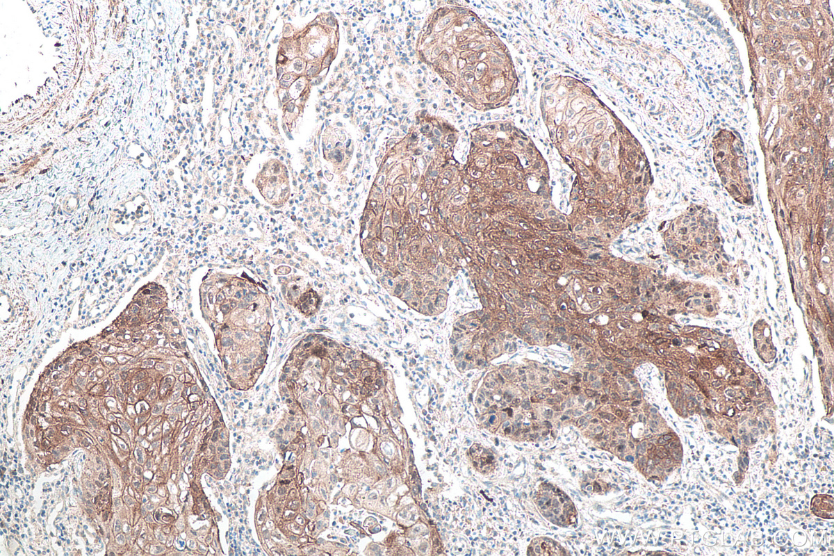 Immunohistochemical analysis of paraffin-embedded human lung cancer tissue slide using KHC0118 (p38 MAPK IHC Kit).