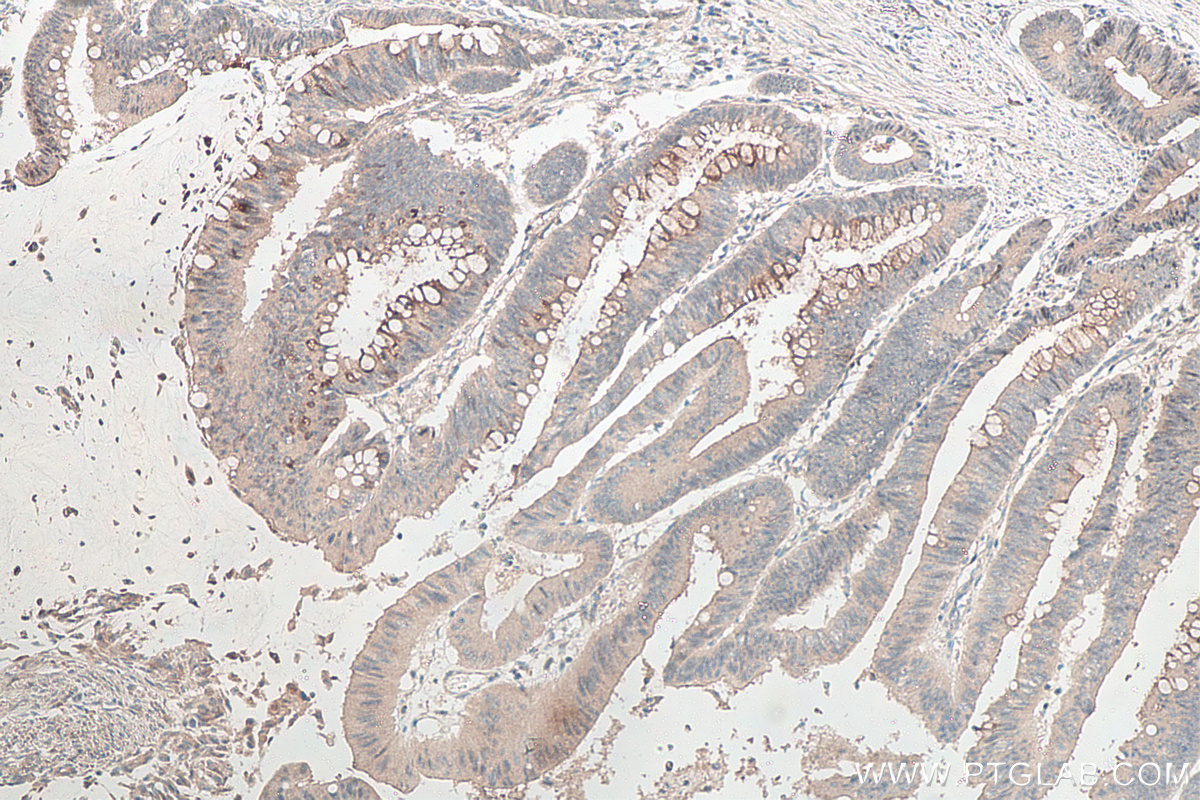 Immunohistochemical analysis of paraffin-embedded human colon cancer tissue slide using KHC0118 (p38 MAPK IHC Kit).