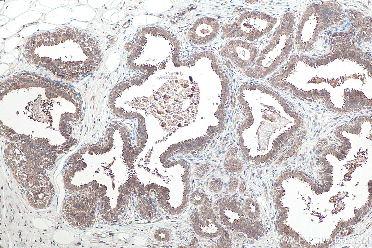 Immunohistochemical analysis of paraffin-embedded human breast cancer tissue slide using KHC0118 (p38 MAPK IHC Kit).