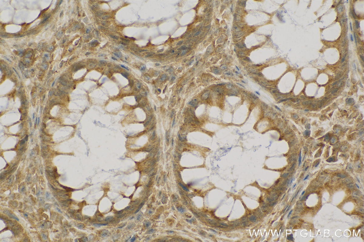 IHC staining of human colon cancer using 13388-1-AP