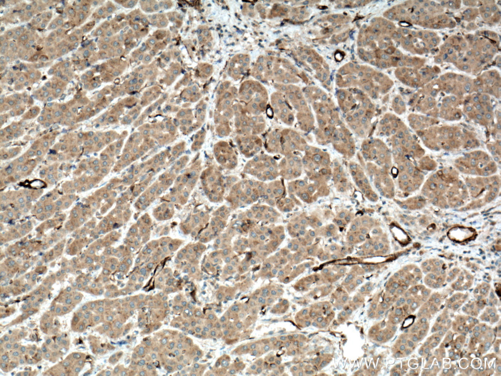 IHC staining of human liver cancer using 15649-1-AP