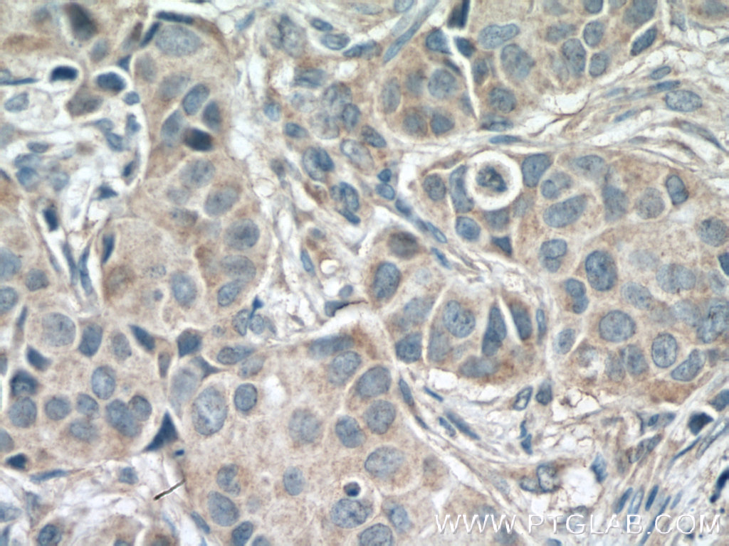 IHC staining of human breast cancer using 66460-1-Ig