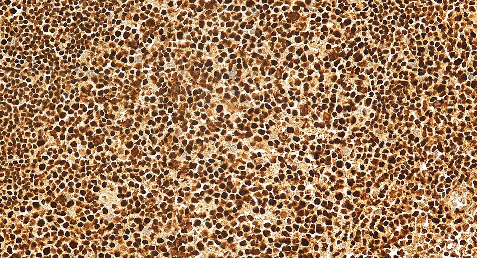Immunohistochemical analysis of paraffin-embedded human tonsillitis tissue slide using 19055-1-AP (Aiolos/IKZF3 antibody) at dilution of 1:200 (under 20x lens). Heat mediated antigen retrieval with Tris-EDTA buffer (pH 9.0). IHC staining of human tonsillitis using 19055-1-AP