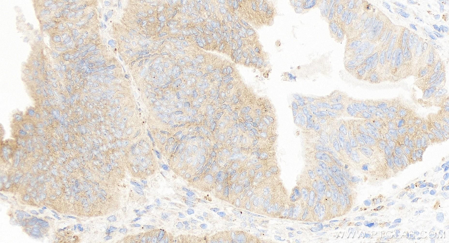 IHC staining of human colon cancer using 84411-5-RR (same clone as 84411-5-PBS)