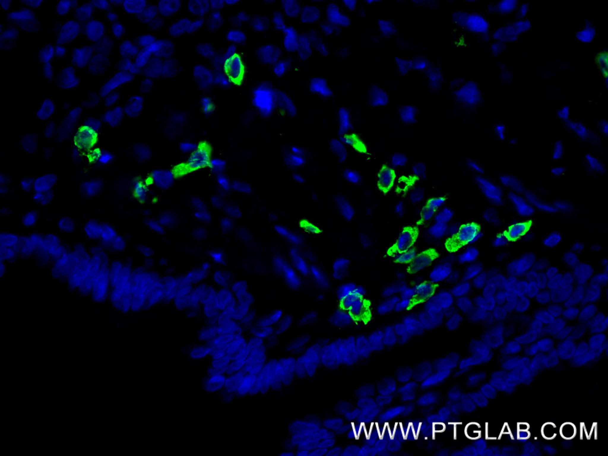 IF Staining of human lung cancer using 82191-3-RR IF Staining of human lung cancer using 82191-3-RR