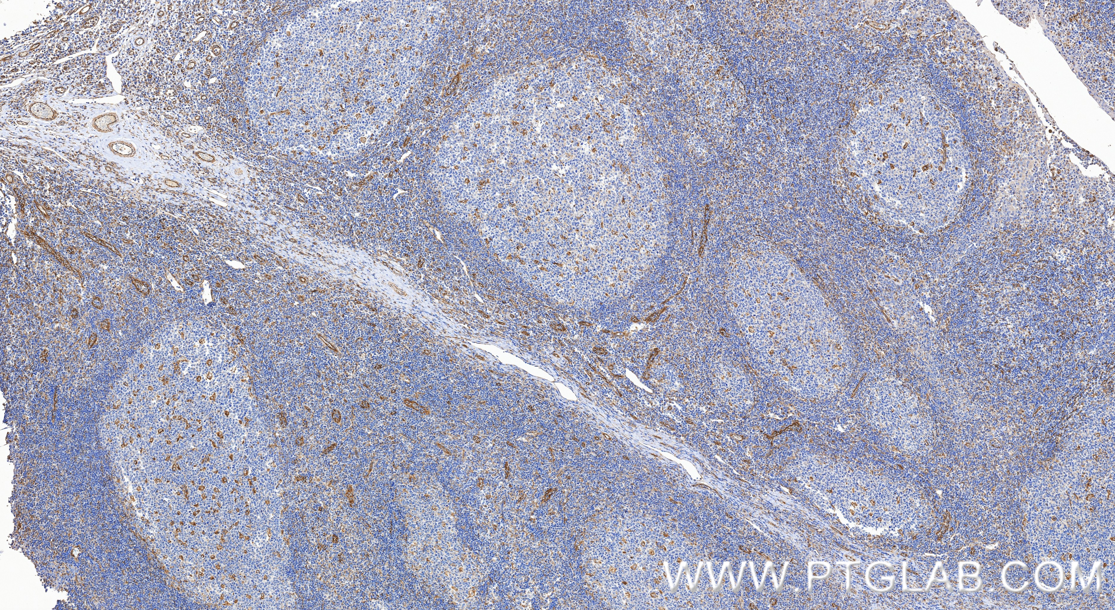 IHC staining of human tonsillitis using 84512-4-RR (same clone as 84512-4-PBS) IHC staining of human tonsillitis using 84512-4-RR (same clone as 84512-4-PBS)