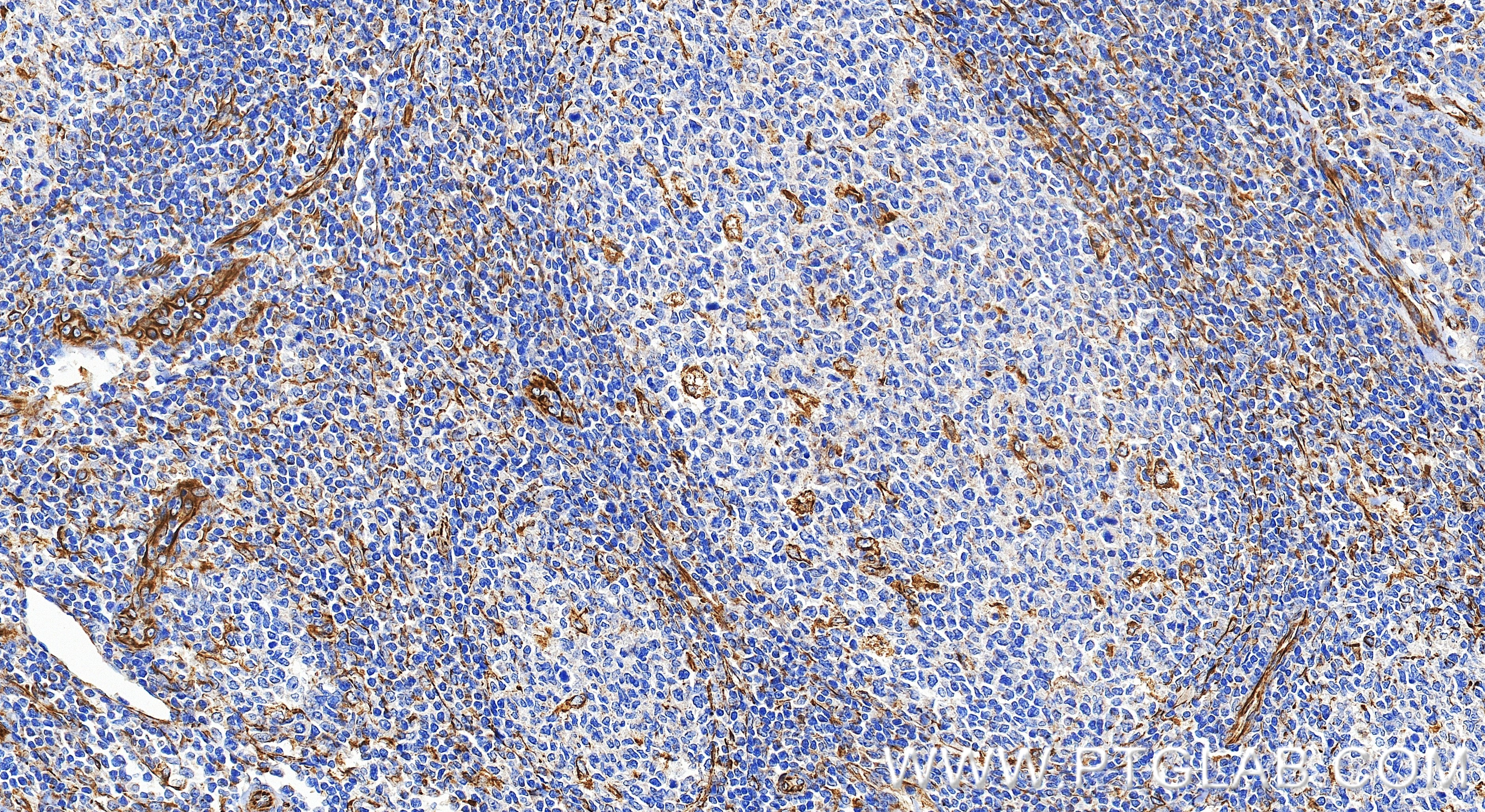 IHC staining of human tonsillitis using 84512-4-RR (same clone as 84512-4-PBS) IHC staining of human tonsillitis using 84512-4-RR (same clone as 84512-4-PBS)