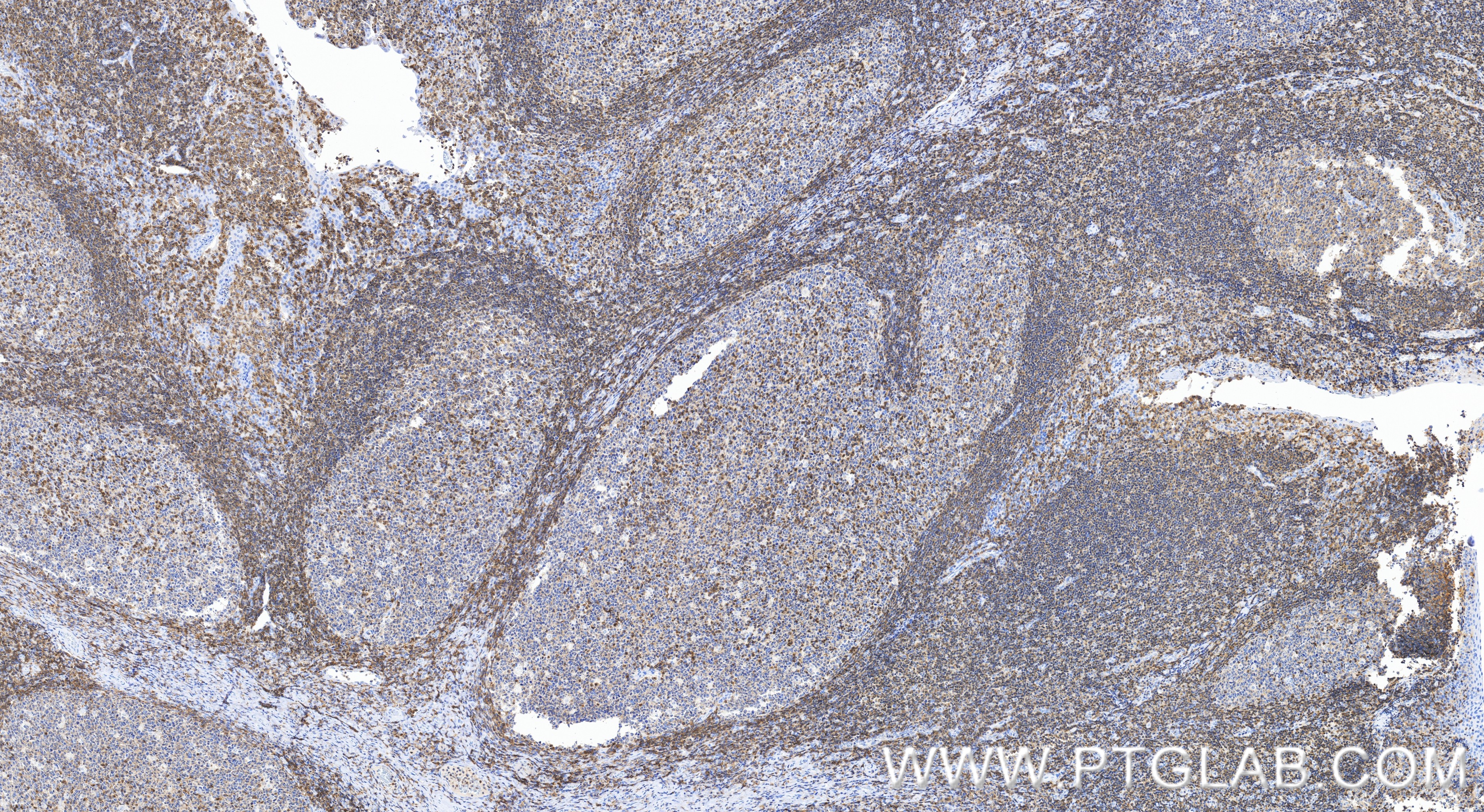 IHC staining of human tonsillitis using 86927-2-RR (same clone as 86927-2-PBS) IHC staining of human tonsillitis using 86927-2-RR (same clone as 86927-2-PBS)