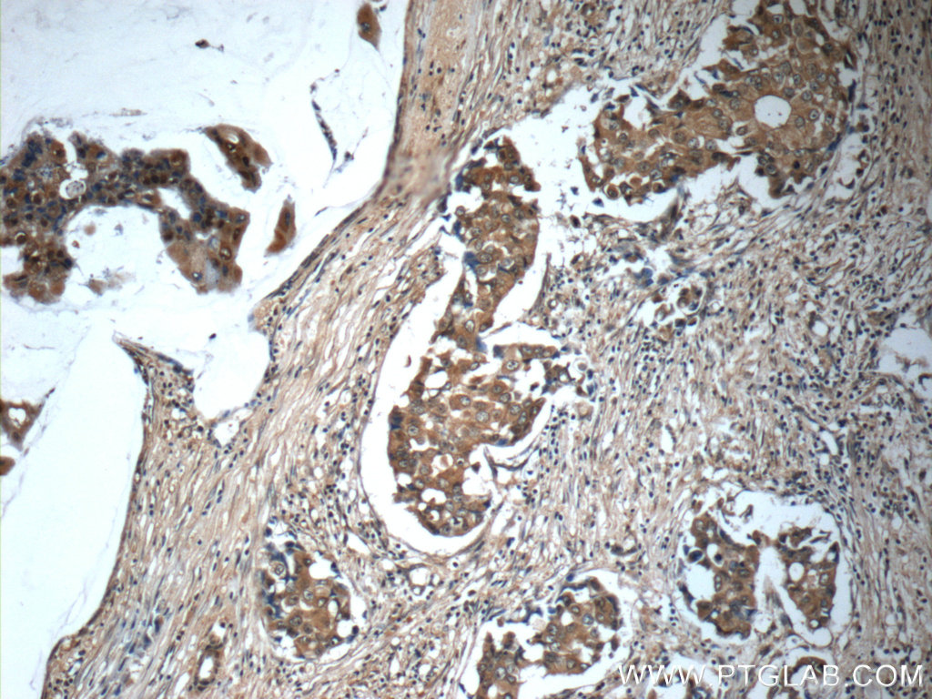 IHC staining of human breast cancer using 24402-1-AP