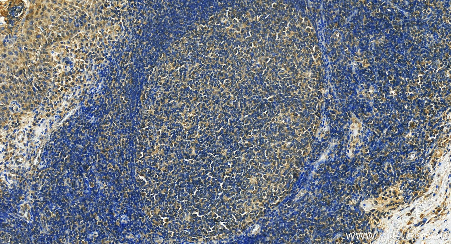 IHC staining of human tonsillitis using 24173-1-AP