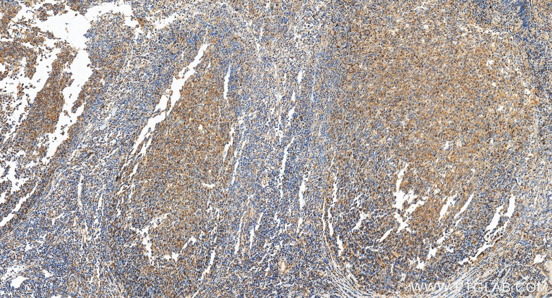 IHC staining of human tonsillitis using 98735-3-RR (same clone as 98735-3-PBS) IHC staining of human tonsillitis using 98735-3-RR (same clone as 98735-3-PBS)