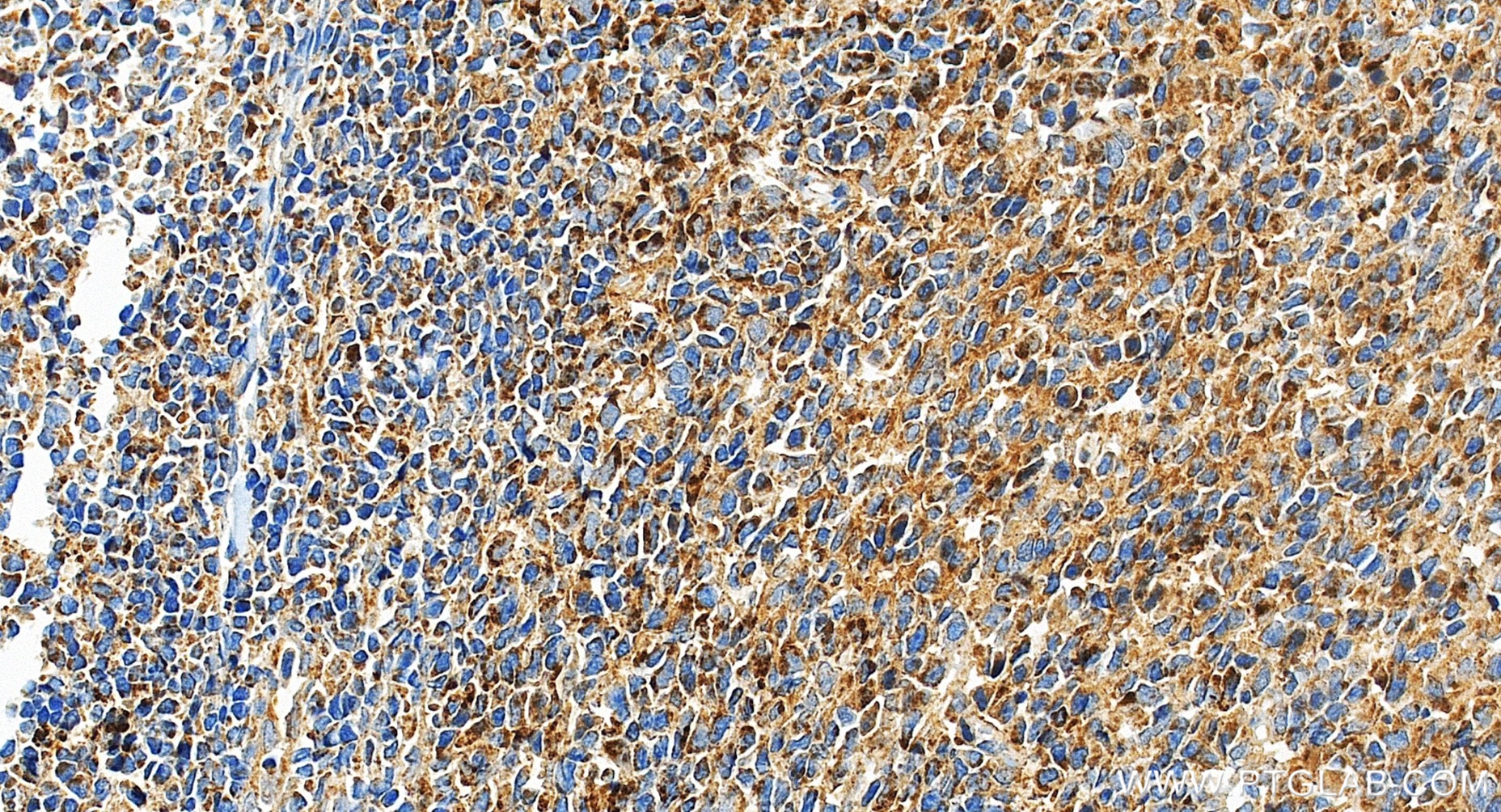 IHC staining of human tonsillitis using 98735-3-RR (same clone as 98735-3-PBS) IHC staining of human tonsillitis using 98735-3-RR (same clone as 98735-3-PBS)