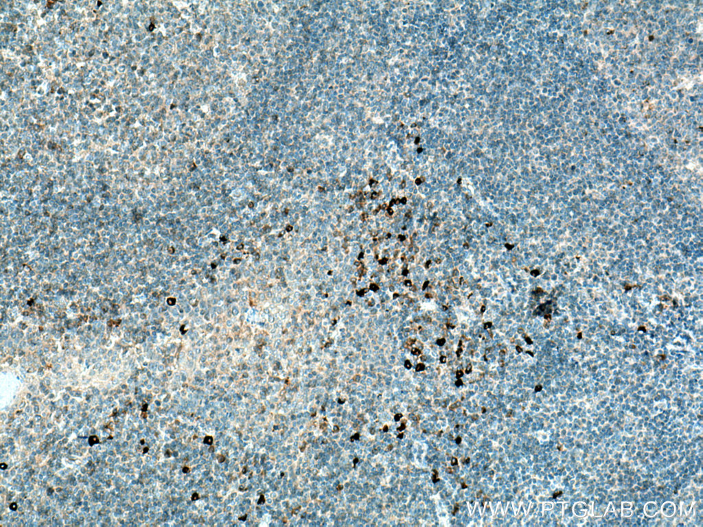 IHC staining of human tonsillitis using 22646-1-AP (same clone as 22646-1-PBS)