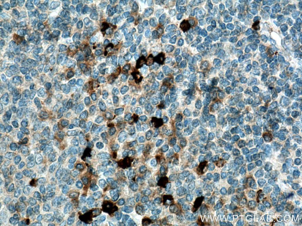 IHC staining of human tonsillitis using 22646-1-AP (same clone as 22646-1-PBS)