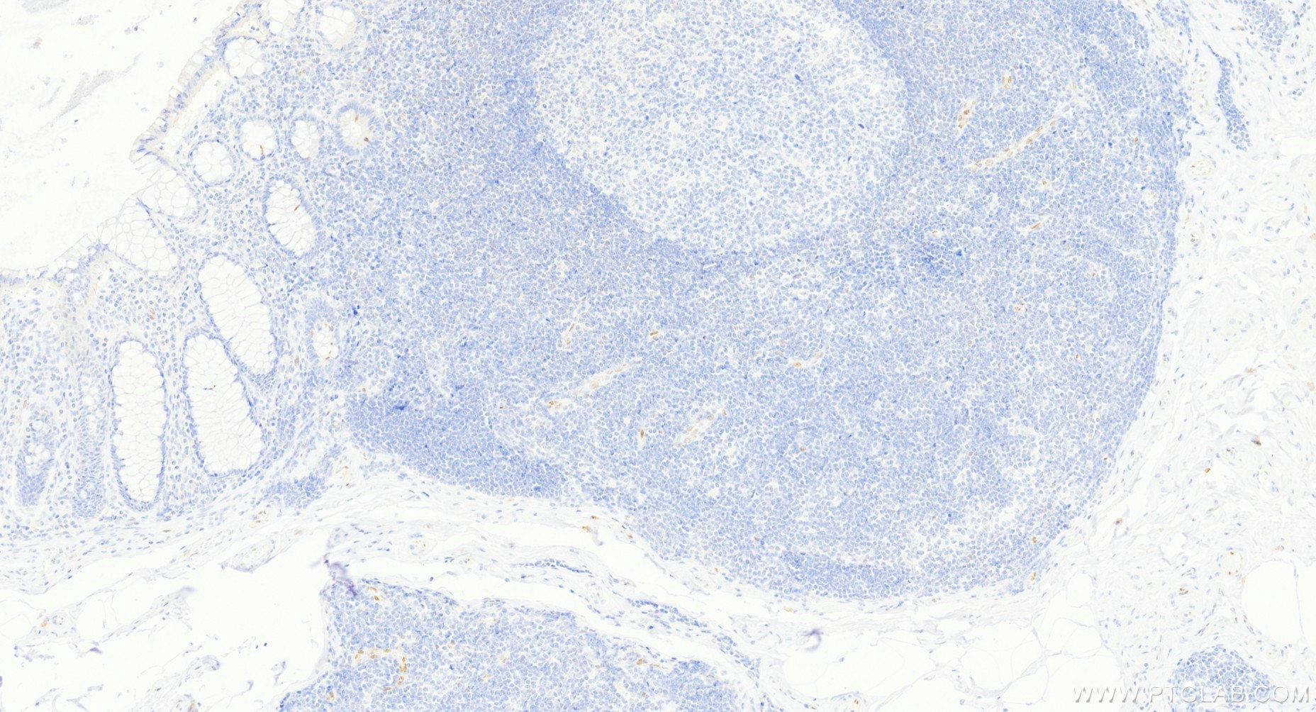 IHC staining of human colon using 98364-2-RR (same clone as 98364-2-PBS) IHC staining of human colon using 98364-2-RR (same clone as 98364-2-PBS)