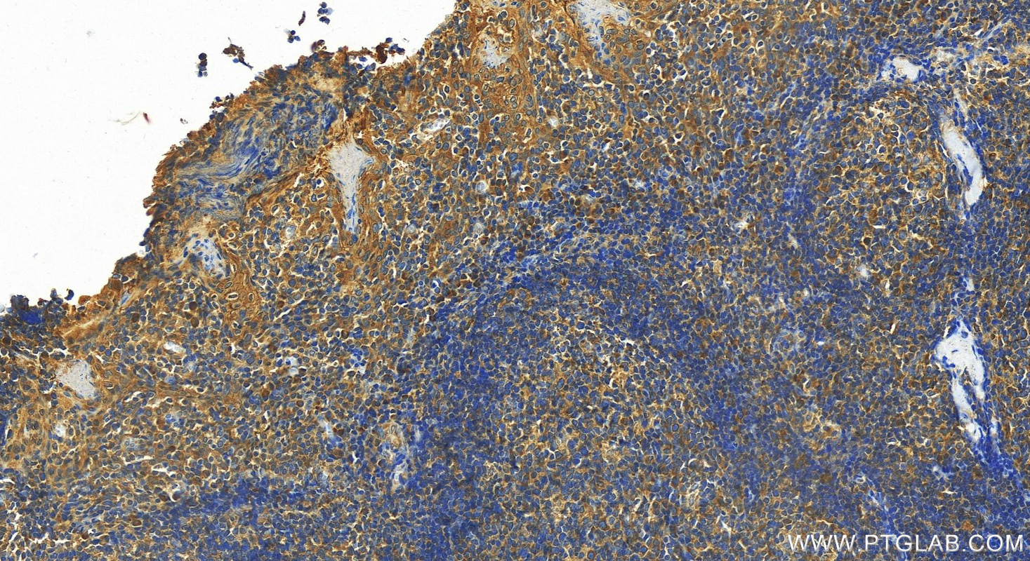 IHC staining of human tonsillitis using 30533-1-AP