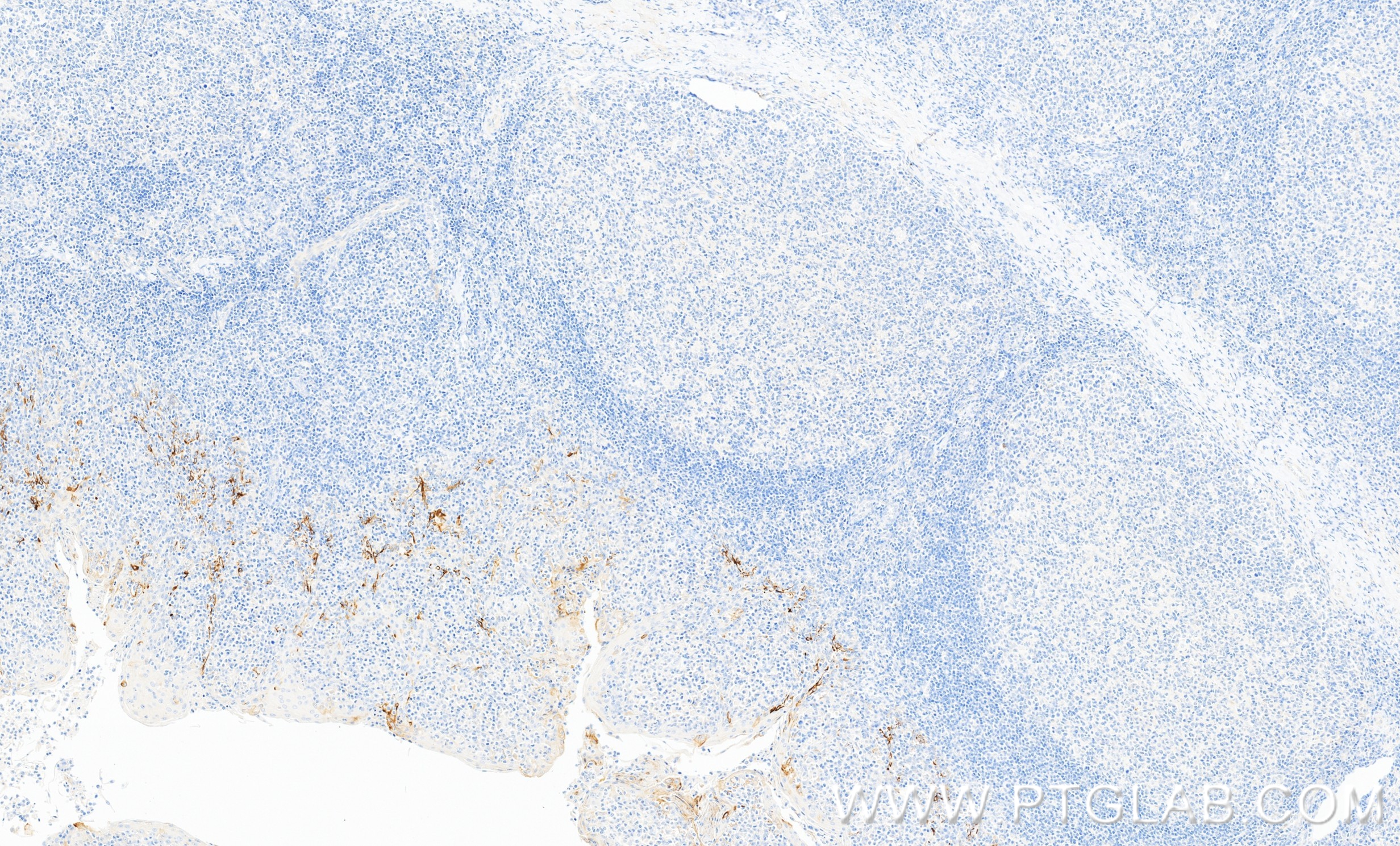 IHC staining of human tonsillitis using 84165-5-RR