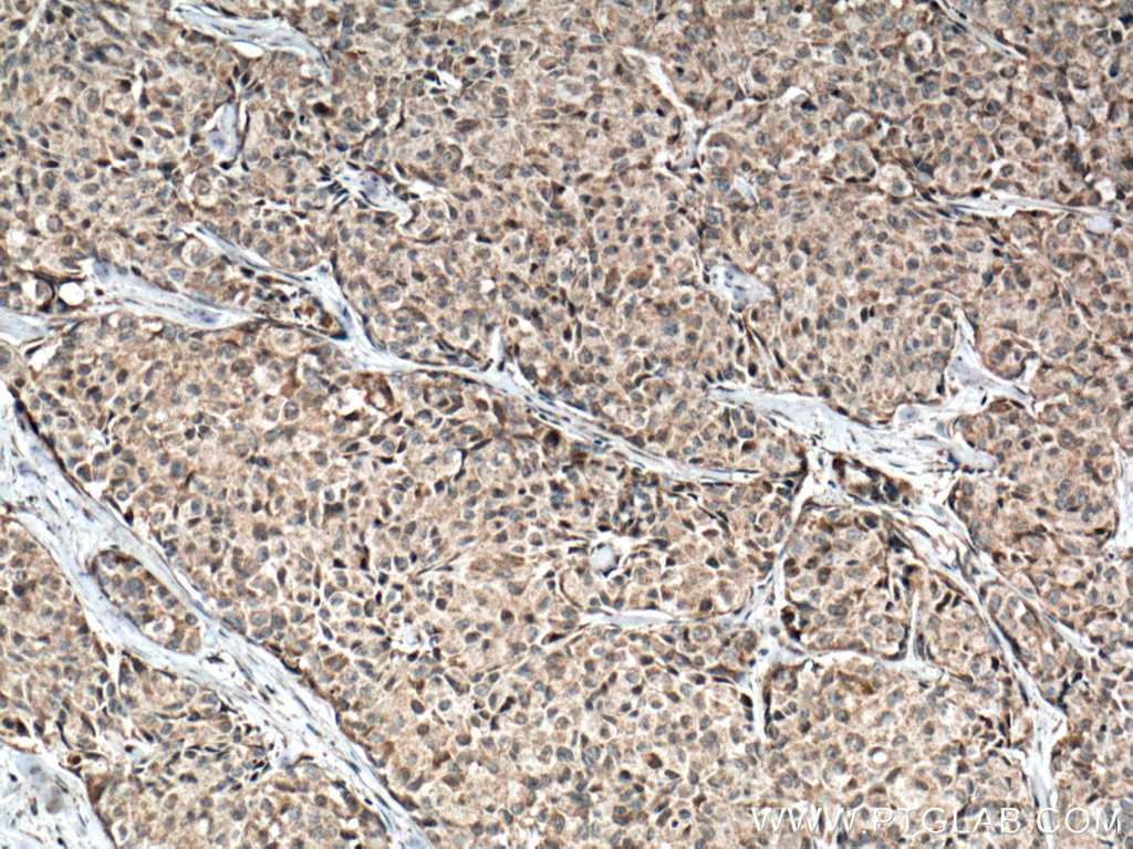 IHC staining of human lung cancer using 66737-1-Ig